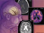 psychologyhealth_dementia1